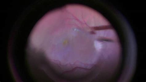 Epiretinal Membrane Surgery - YouTube