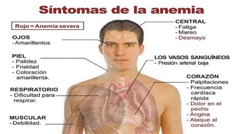 29+ Anemia En Niños Sintomas Y Tratamiento UK - Helen T. Childs