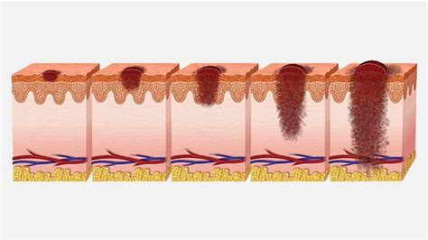 Metastatic Melanoma: Symptoms, Stages, Treatment | Christ Memorial