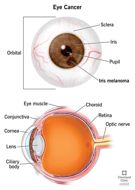Eye Cancer: Symptoms, Types & Treatment
