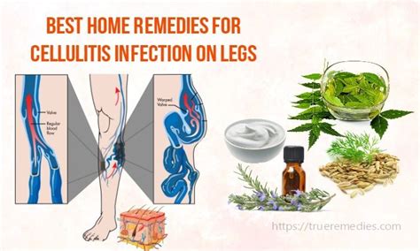 22 Best Home Remedies For Cellulitis Infection On Legs