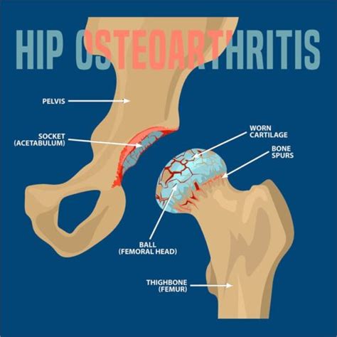 Osteoarthritis of the Hip | Florida Orthopaedic Institute