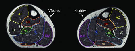 Soleus Muscle Mri