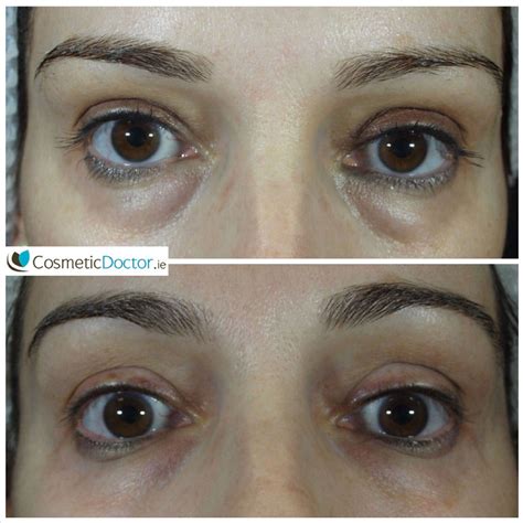 Before and 1 month after tear trough treatment with fillers - Cosmetic Doctor Dublin