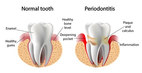 Perio Protect® | Dentist in Santa Maria, CA