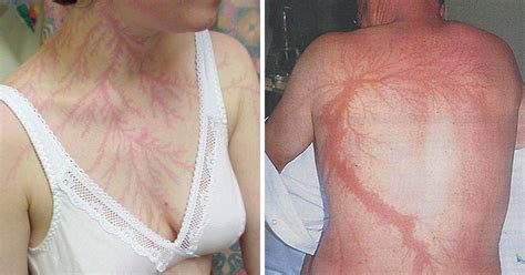 20 People Who Survived Getting Struck By Lightning Show What It Does To Your Skin | Bored Panda