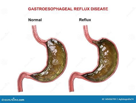 Gastroesophageal Reflux Disease - Failure of the Digestive Mechanism ...