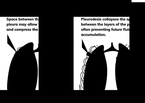 Pleurodesis | Surgery for Pleural Mesothelioma Symptom Relief