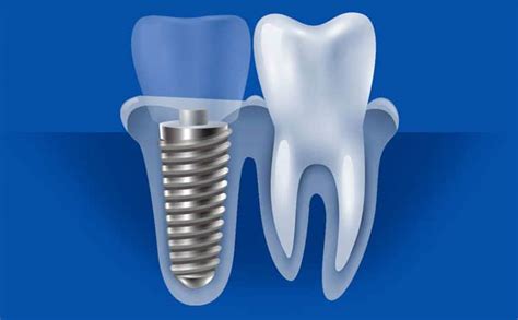 Dental Implants | Titanium | Preferred Choice | Memphis