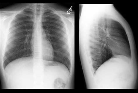 Neat How To Report Normal Chest X Ray Write A Good Introduction For Research