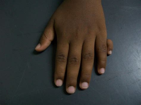 The Genetics Behind Why 6 Fingers Per Hand, Not 5, Is the Dominant Trait