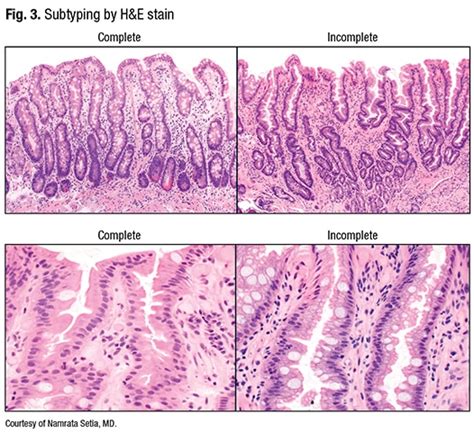 Gastric intestinal metaplasia—the need to classify and how - CAP TODAY