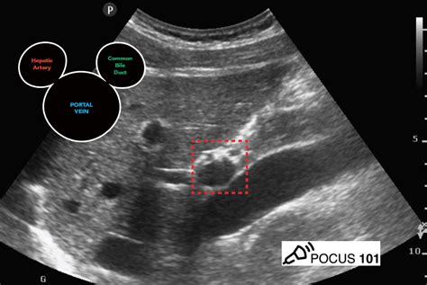 Gallbladder Mickey Mouse Sign