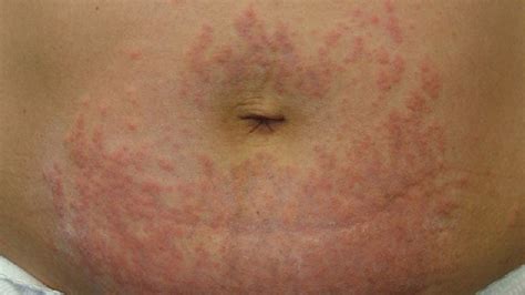 Rash on the abdomen – Anxiety Fighters Guide