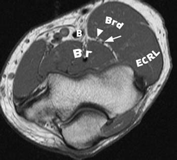 Posterior Interosseous Nerve Syndrome | Radsource