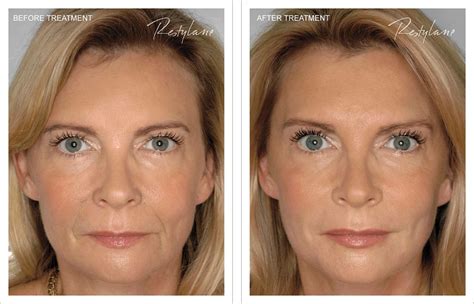 Restylane Under Eye Filler Before And After - All You Need Infos