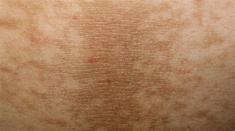 Acanthosis Nigricans: Appearance, Causes, and Treatment