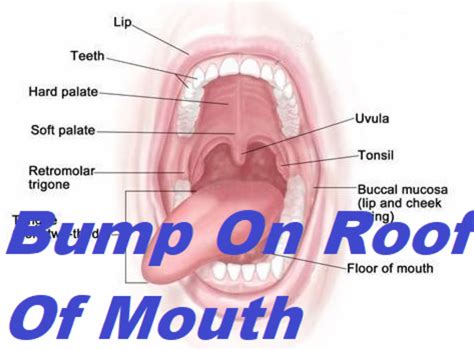 Bump On Roof Of Mouth Std Archives – Grow Health