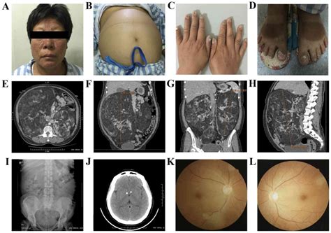 Familial genetic tuberous sclerosis complex associated with bilateral giant renal angiomyolipoma ...