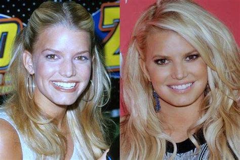 Jessica Simpson Plastic Surgery Before And After Photos