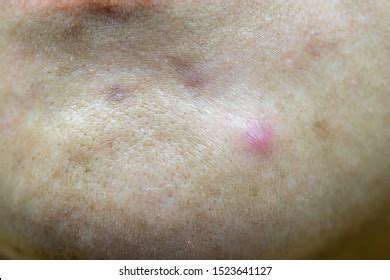 Photo Nodular Cystic Acne Skin Chronic Stock Photo (Edit Now) 1523641127