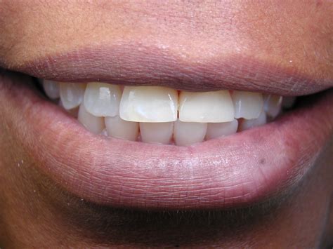 Closing a Mid-line Gap Between Upper Teeth – Dr. Mark Venincasa, DDS | General & Cosmetic ...