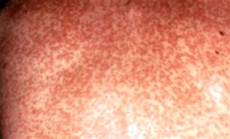 Rubella - Virus, Vaccine, Pictures, Symptoms, What is, Rash, Treatment