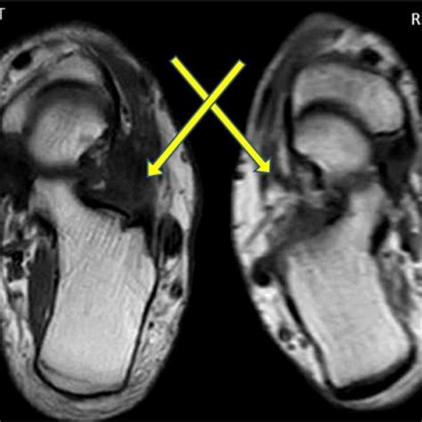 Sinus Tarsi Mri