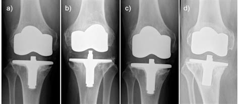 High-flex knees with aseptic loosening of the cemented tibial ...