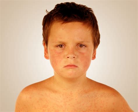 Measles Rash – Symptoms, Causes, Treatment, Pictures | Symptoms Causes Treatment and Prevention ...