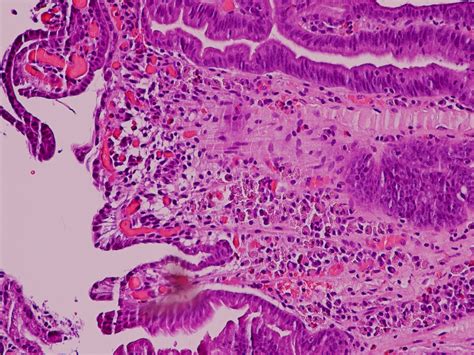 Pathology Outlines - Russell body gastritis