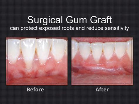 Gum Graft Surgery Before And After Pictures