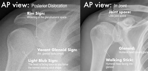 Posterior Shoulder Dislocation – EMbeds.co.uk