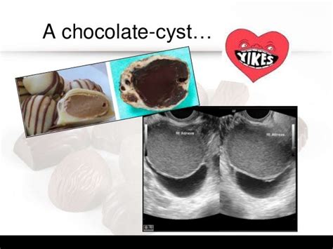 Chocolate cyst a trick or a treat