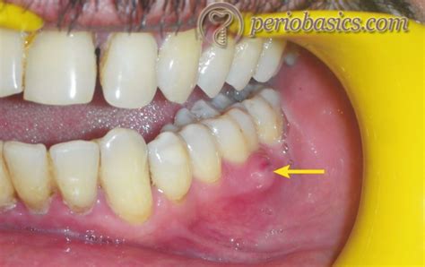 Absceso Apical Agudo