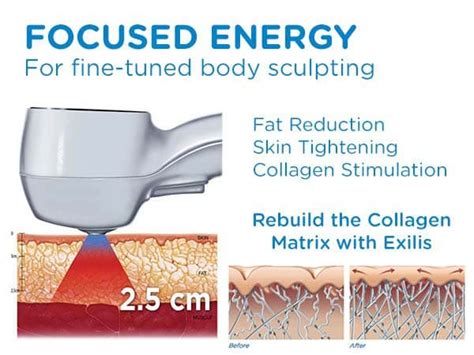 Bonus Treatment: Free Exilis Ultra Skin Tightening Treatment