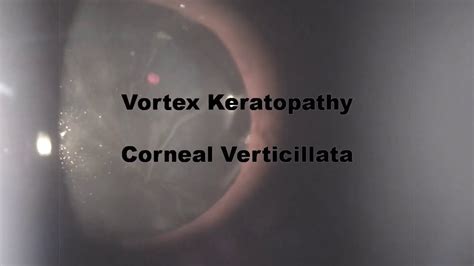 Whorl Keratopathy