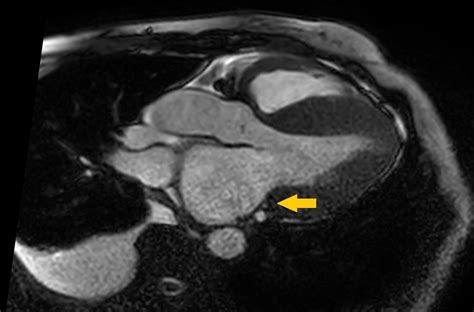 Amyloidosis MRI - wikidoc