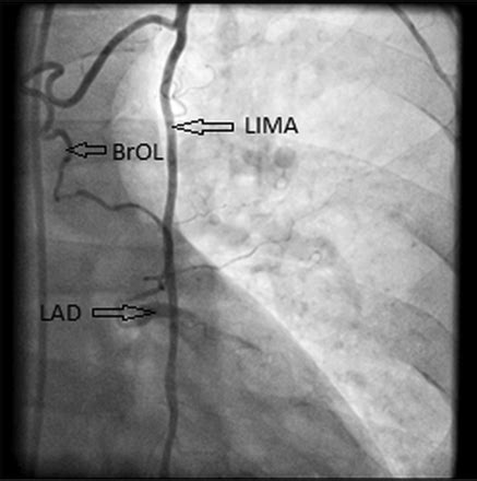 A rare case of natural bypass from LIMA to LAD | Heart Asia