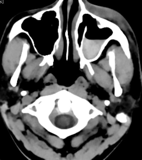 Blow Out Fracture-MDCT - Sumer's Radiology Blog