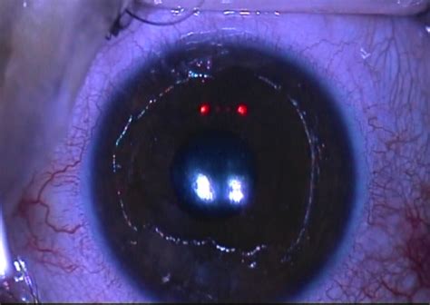 CXL: Corneal Collagen Cross Linking