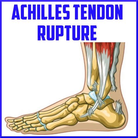 Achilles Tendon Rupture