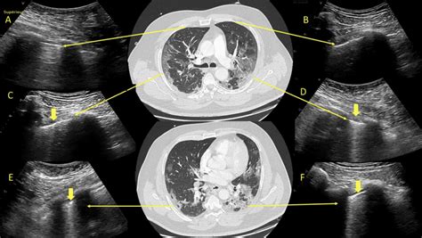 COVID-19: Laboratory and Imaging Abnormalities - REBEL EM - Emergency Medicine Blog