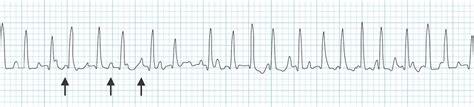 Supraventricular Tachycardia Rhythm Strip