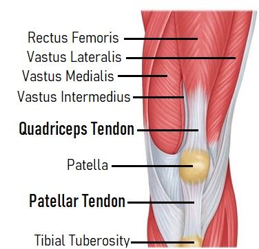 Quadriceps Tendonitis