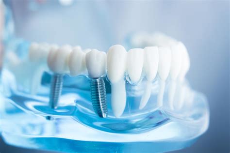 Getting involved in implant dentistry – are your surgical skills good ...