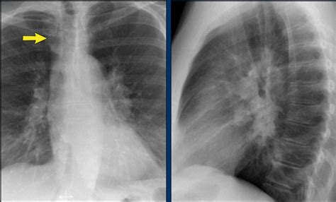 Normal Lateral Chest Xray