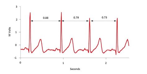 Heart Rate Variability (HRV)