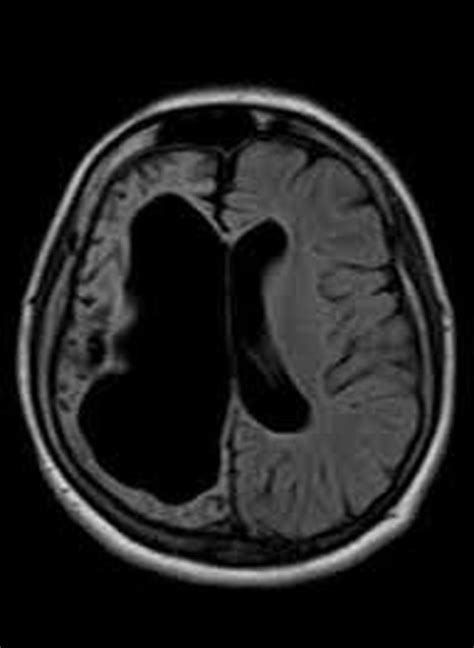 Rasmussen encephalitis - MEDizzy