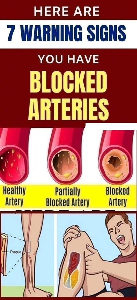 Here Are 7 Warning Signs You Have Blocked Arteries in 2020 | Arteries ...